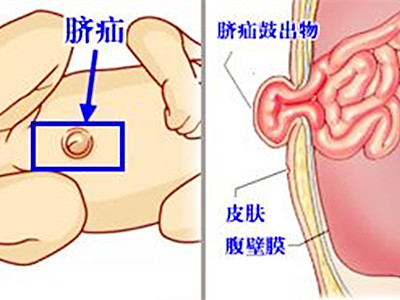 小孩患脐疝后常哭闹,因此家长就特别着急.