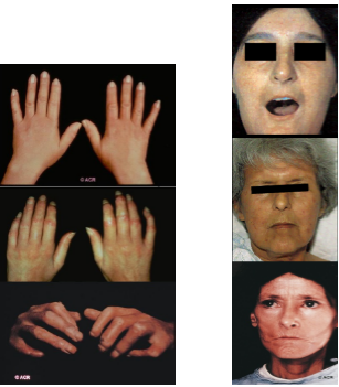 疾病科普硬皮病到底是一种什么样的疾病