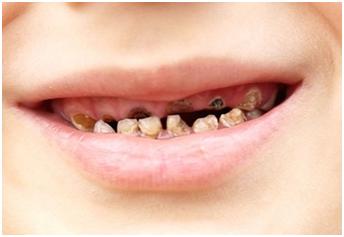 【儿童口腔健康】孩子牙齿变黑的原因是什么?