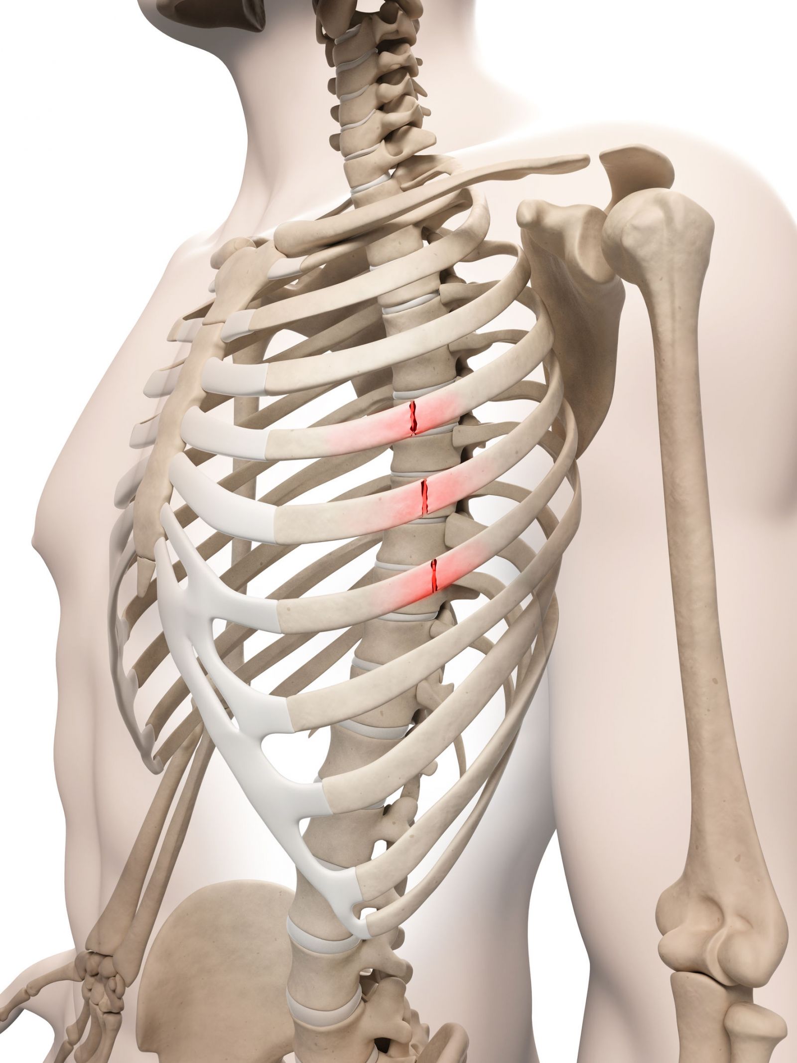 疾病贴士肋骨骨折的治疗措施与康复训练